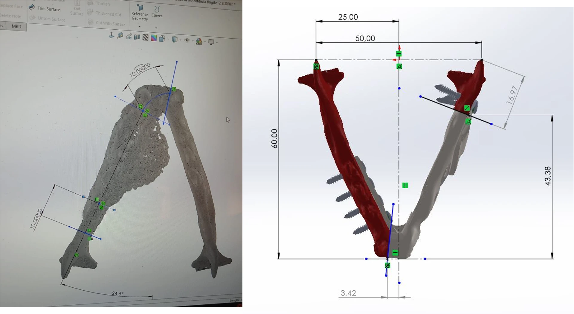 Planeamento mandibular com medições e implantes