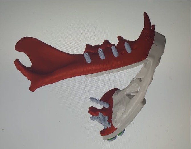 Reconstrução mandibular com implantes personalizados